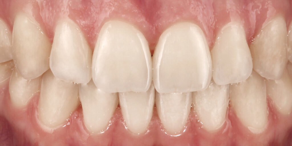 ormco-spark-innovative-advanced-clear-aligner-system