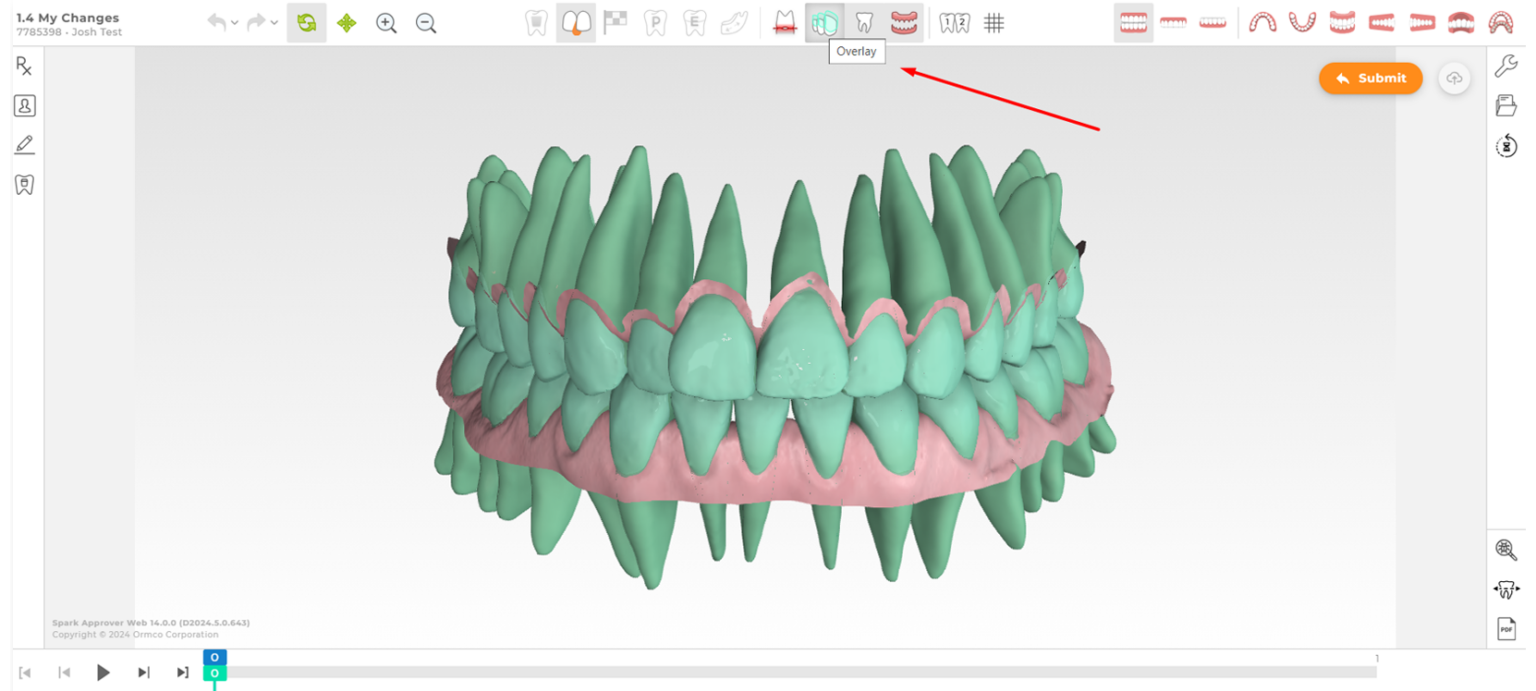 Ormco - Spark™ Releases - Latest Updates on Spark Aligners